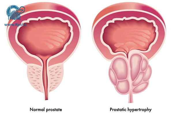 هایپرپلازی خوش خیم پروستات