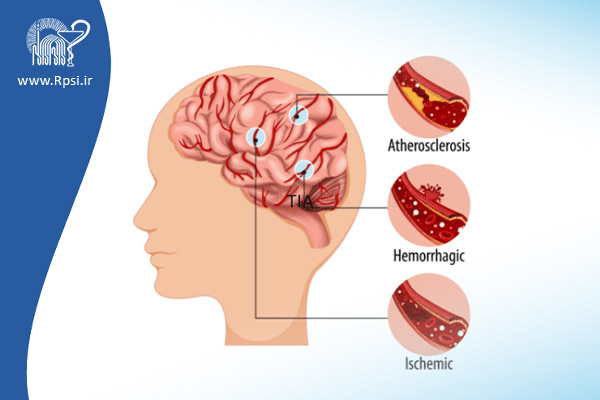 سکته مغزی