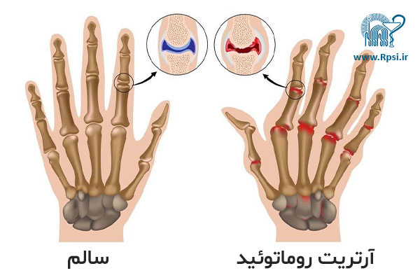 روماتیسم