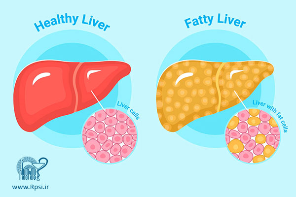 کبد چرب