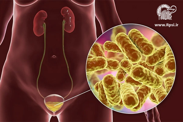 سیستیت یا التهاب مثانه