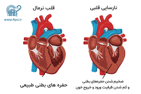 نارسایی قلبی