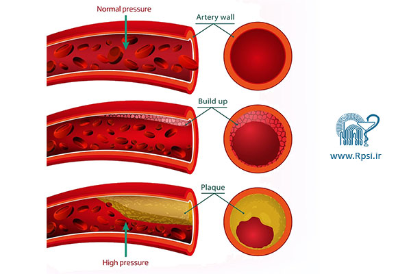 فشارخون بالا