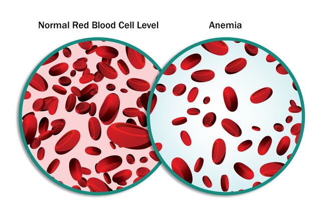 What Are the Symptoms of Anemia