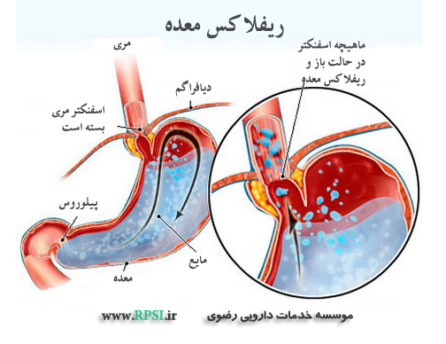 ناراحتی های گوارشی