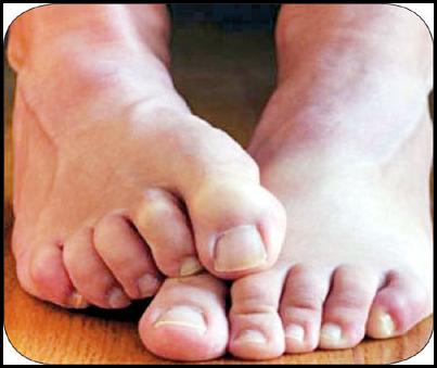 نشانه‌های سندرم "پای بیقرار" چیست و چه درمانی دارد