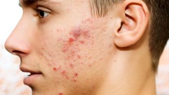 New Acne Treatment Might Spring FromIsotretinoin (Myorisan)