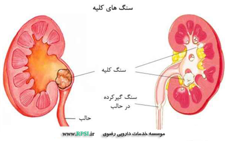 سنگ کلیه و راههای درمان سنگ کلیه