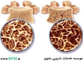 Osteoporosis Overview