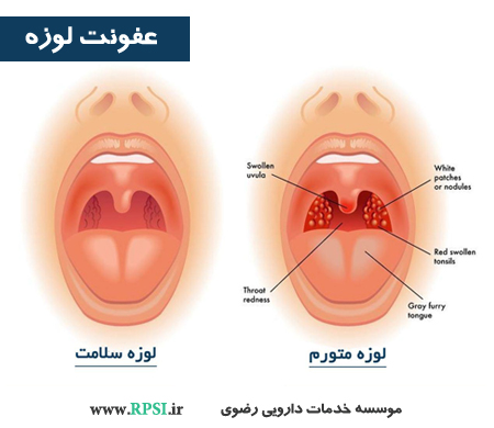 عفونت های لوزه را چگونه از بین ببریم؟