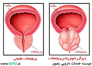 آزمایش PSA  (آزمایش تشخیص سرطان پروستات )