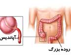 Appendicitis