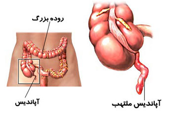 آپاندیسیت ؛ علل علائم و درمان