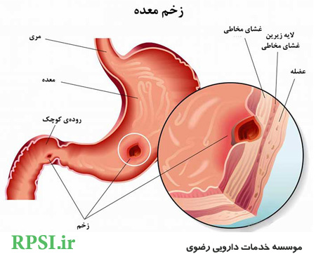 بیماری زخم معده ، علائم و درمان آن