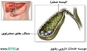 سنگ کیسه صفرا با درمان دارویی، قابل درمان است