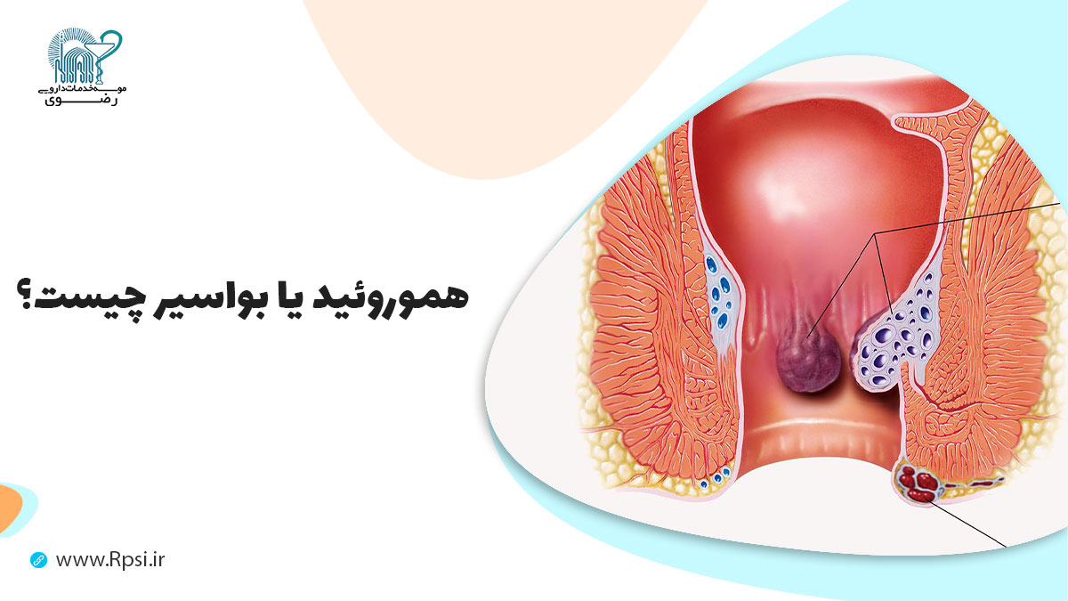 علل هموروئید یا بواسیر چیست؟ به همراه نکاتی برای پیشگیری