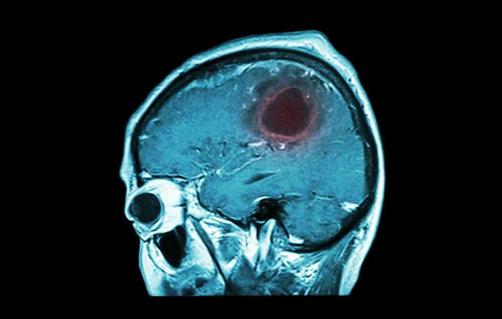 علائم و نشانه های هشدار دهنده تومور مغزی