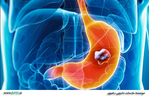 سرطان معده ، علل ، علائم  و درمان