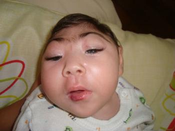 Zika does cause microcephaly, but questions remain