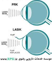 PRK (photorefractive keratectomy) 