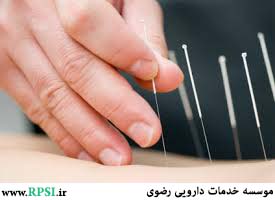 What Is Acupuncture? What Are The Benefits Of Acupuncture?